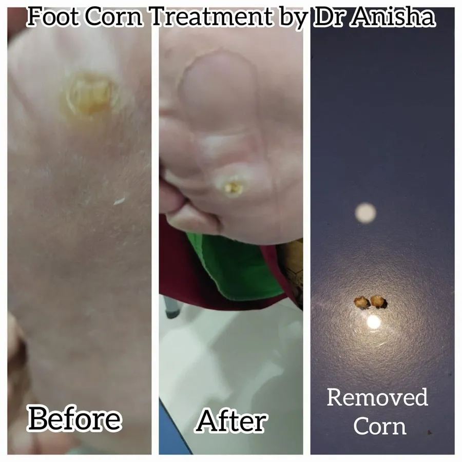 Foot Corn Successfully Treated