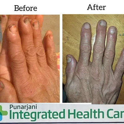 Nail Infection Successfully Treated