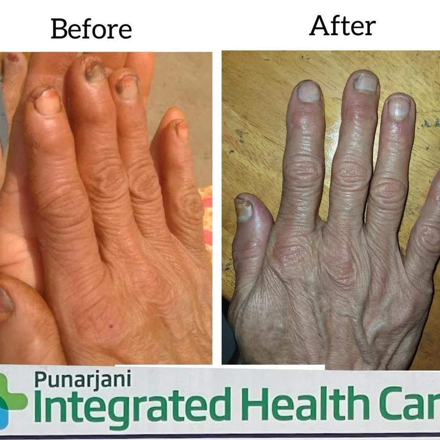 Nail Infection Successfully Treated