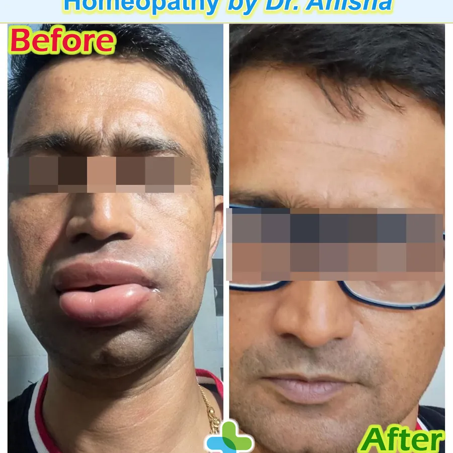 Urticaria (Hives) Cured with Homeopathy